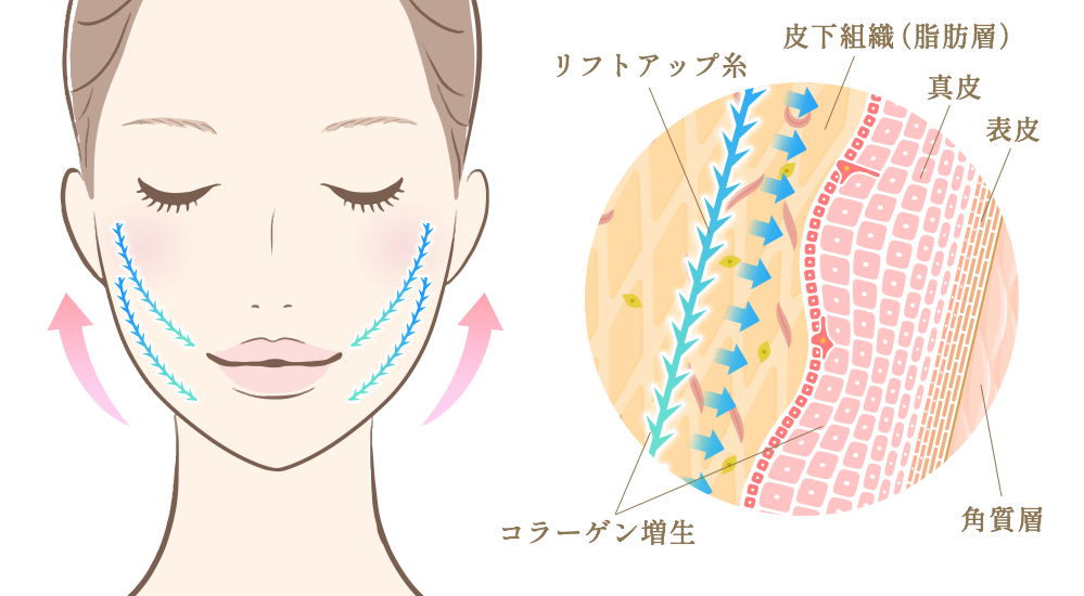 切らないリフトアップ治療